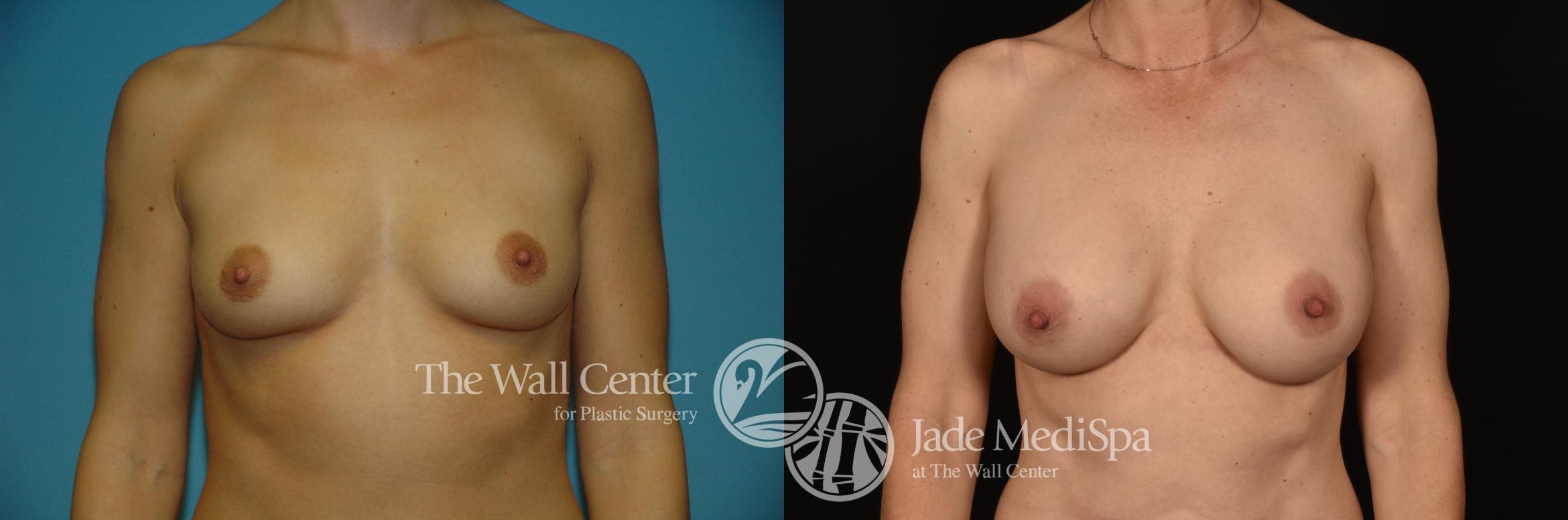 Before & After Breast Augmentation Case 1189 Front View in Shreveport, LA