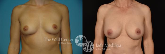 Before & After Breast Augmentation Case 1189 Front View in Shreveport, LA