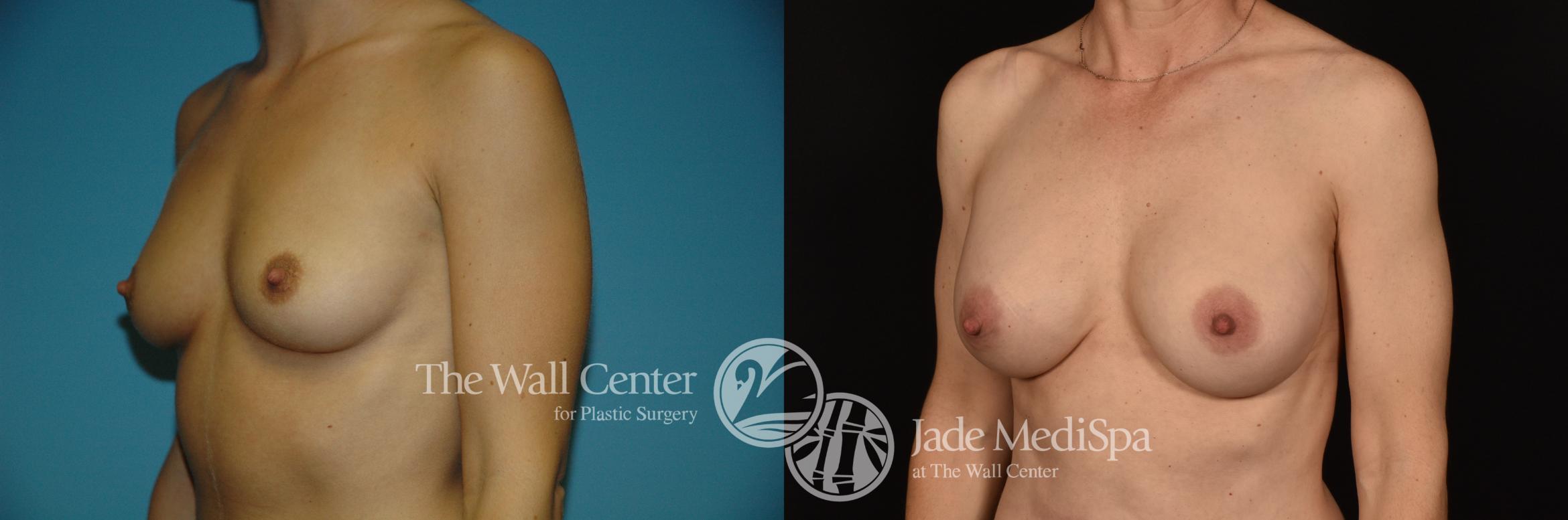 Before & After Breast Augmentation Case 1189 Left Oblique View in Shreveport, LA