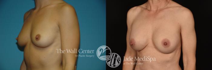 Before & After Breast Augmentation Case 1189 Left Oblique View in Shreveport, LA
