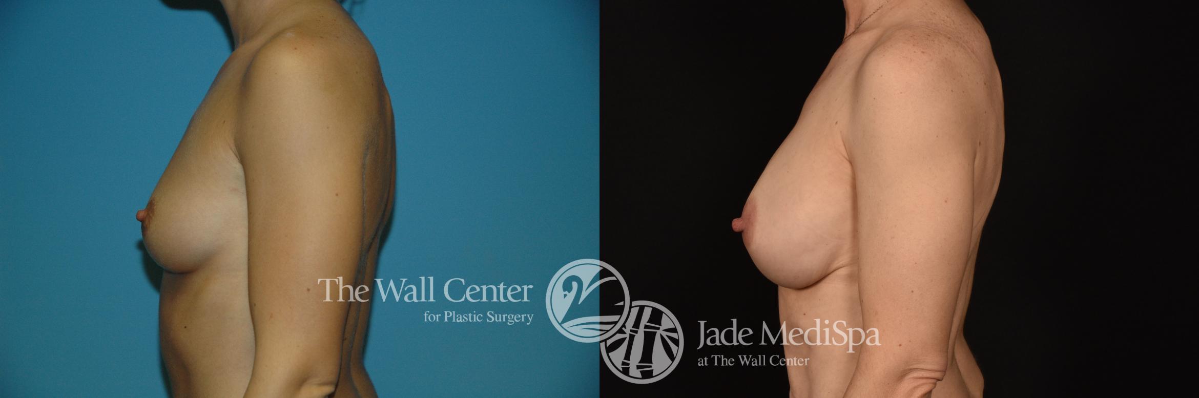 Before & After Breast Augmentation Case 1189 Left Side View in Shreveport, LA