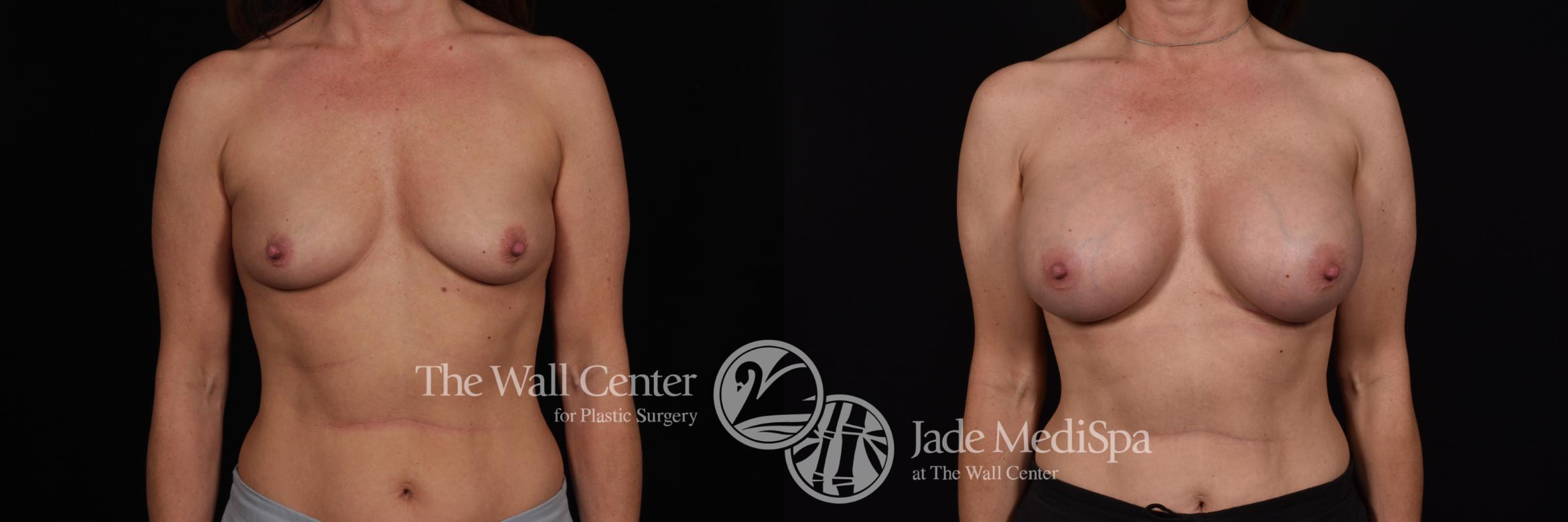Before & After Breast Augmentation Case 1190 Front View in Shreveport, LA