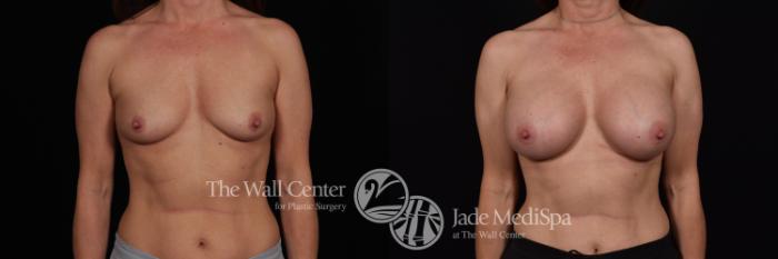 Before & After Breast Augmentation Case 1190 Front View in Shreveport, LA