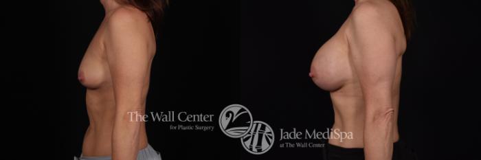 Before & After Breast Augmentation Case 1190 Left Side View in Shreveport, LA
