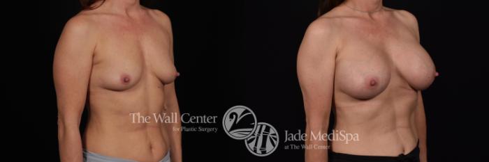Before & After Breast Augmentation Case 1190 Right Oblique View in Shreveport, LA