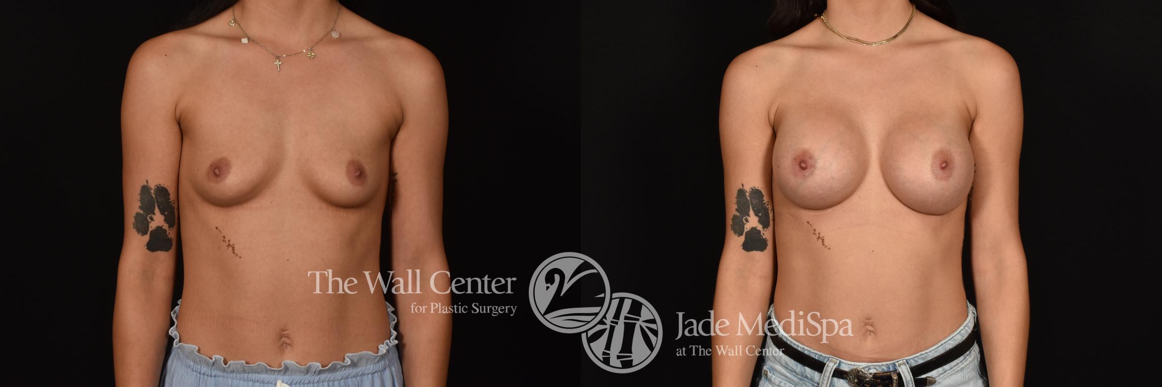Before & After Breast Augmentation Case 1196 Front View in Shreveport, LA