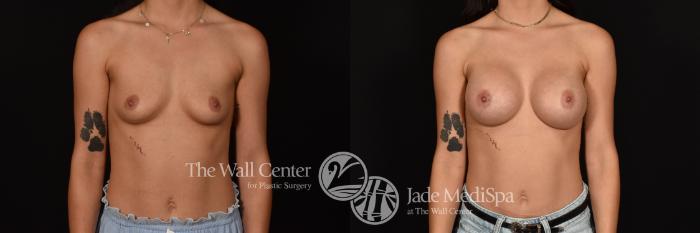 Before & After Breast Augmentation Case 1196 Front View in Shreveport, LA