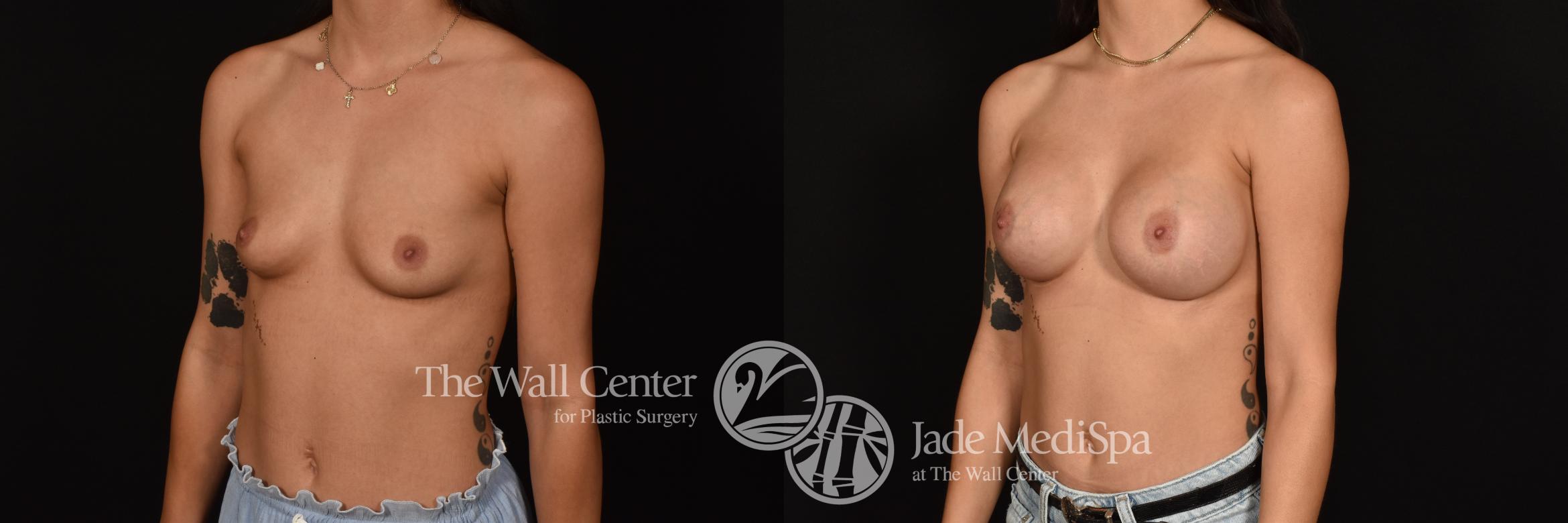Before & After Breast Augmentation Case 1196 Left Oblique View in Shreveport, LA