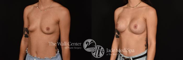 Before & After Breast Augmentation Case 1196 Left Oblique View in Shreveport, LA