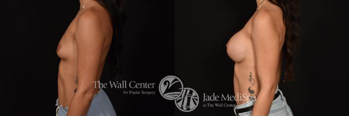 Before & After Breast Augmentation Case 1196 Left Side View in Shreveport, LA