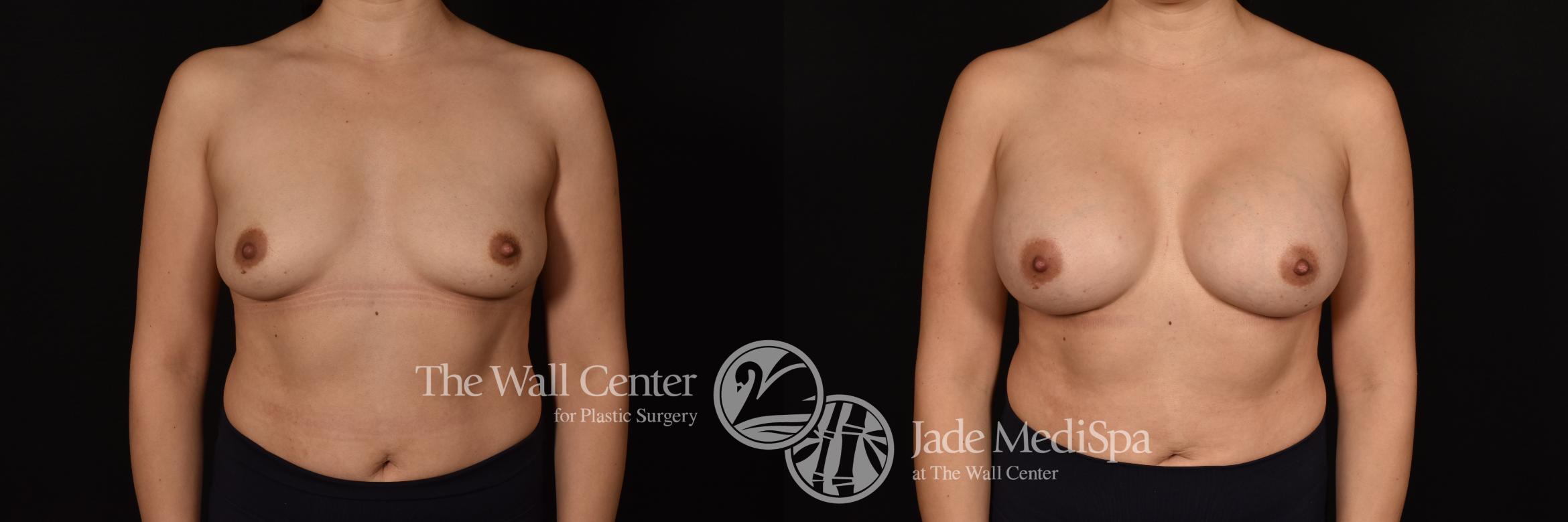 Before & After Breast Augmentation Case 1200 Front View in Shreveport, LA