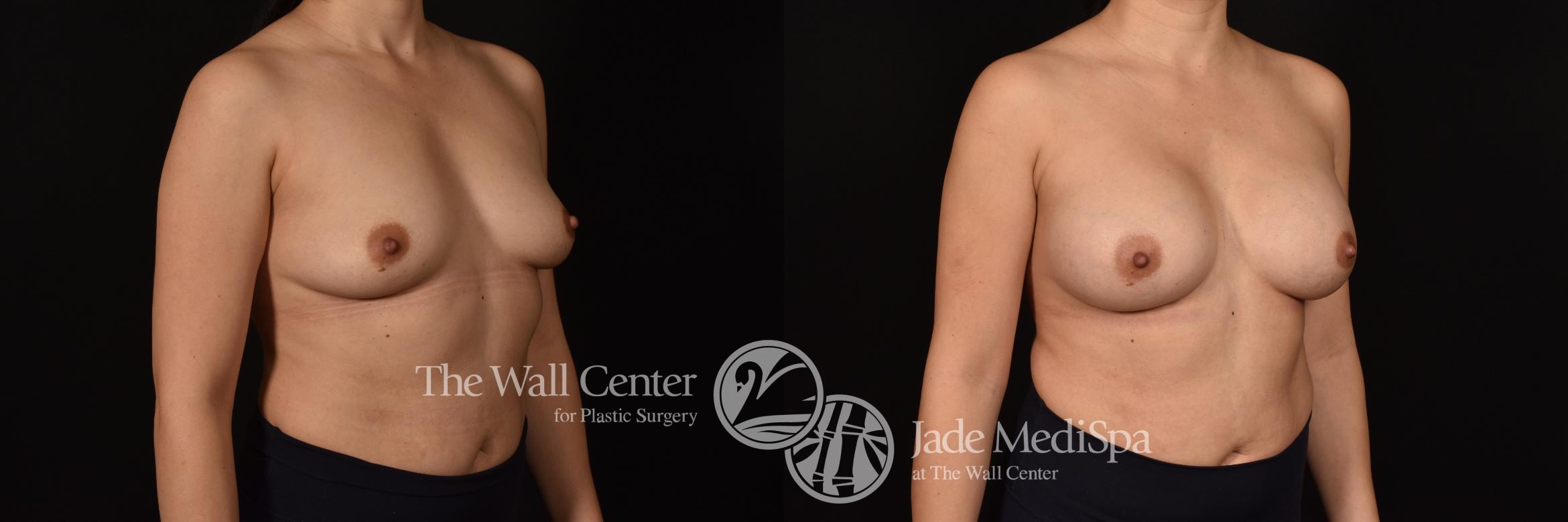 Before & After Breast Augmentation Case 1200 Right Oblique View in Shreveport, LA