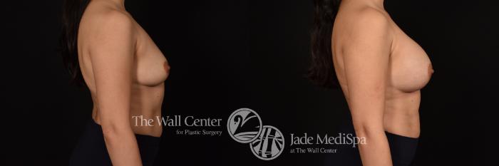 Before & After Breast Augmentation Case 1200 Right Side View in Shreveport, LA