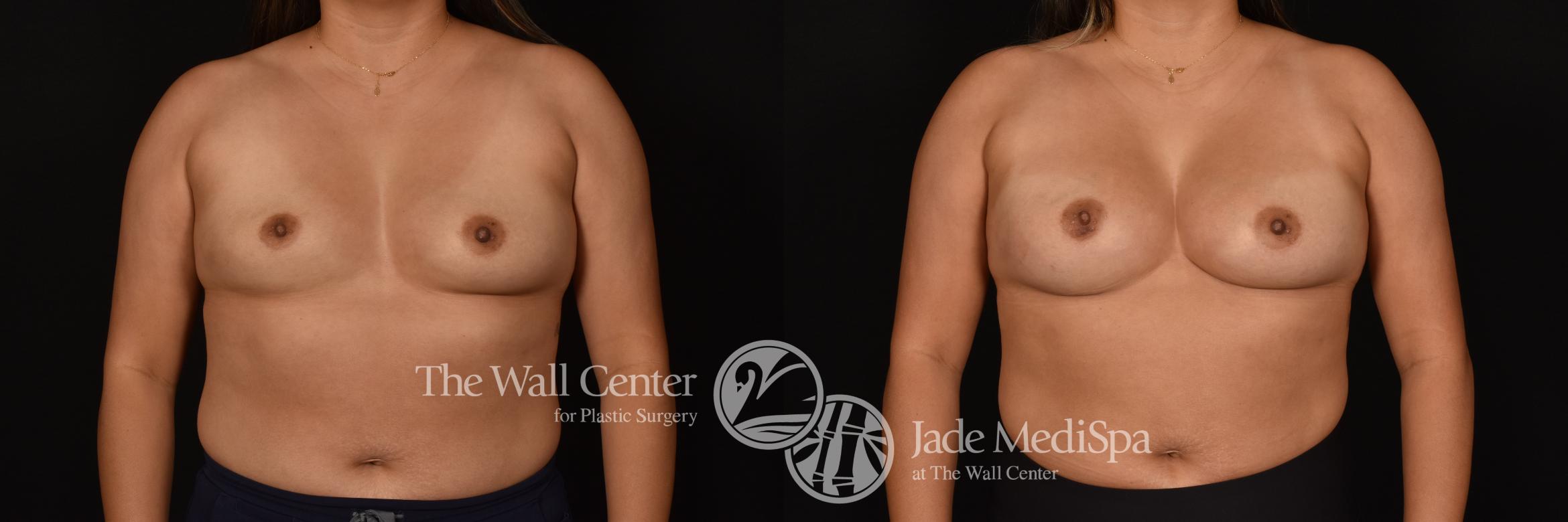 Before & After Breast Augmentation Case 1204 Front View in Shreveport, LA