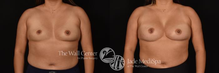 Before & After Breast Augmentation Case 1204 Front View in Shreveport, LA