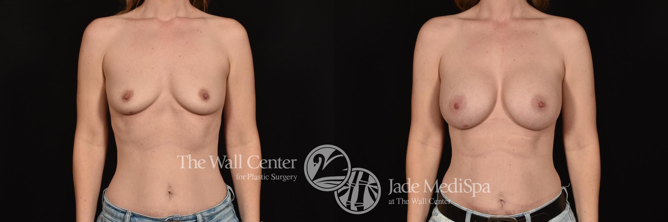 Before & After Breast Augmentation Case 1206 Front View in Shreveport, LA
