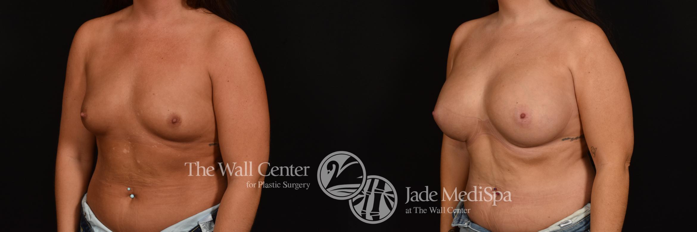 Before & After Breast Augmentation Case 1209 Left Oblique View in Shreveport, LA