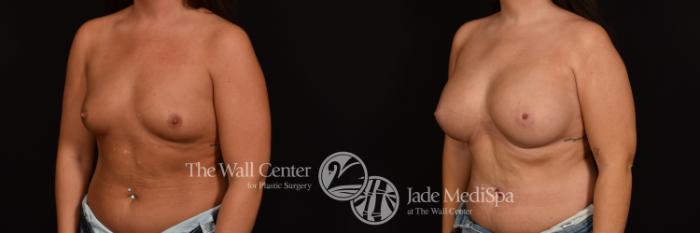 Before & After Breast Augmentation Case 1209 Left Oblique View in Shreveport, LA