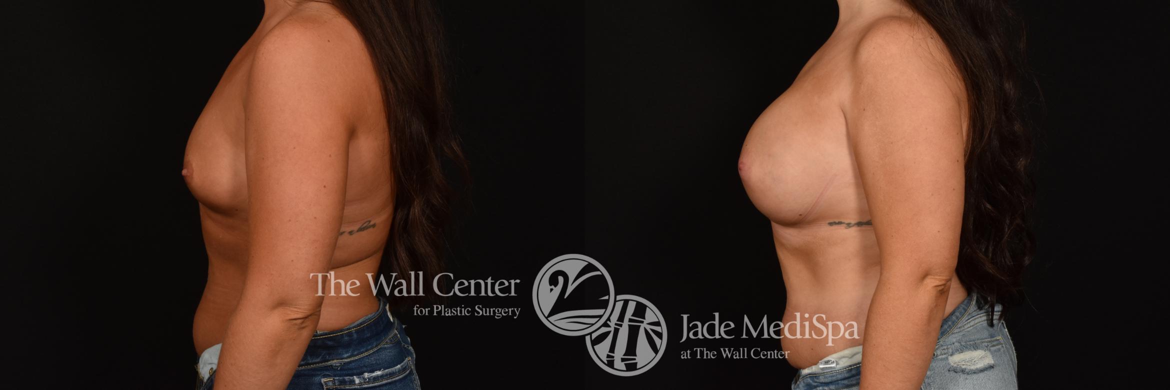 Before & After Breast Augmentation Case 1209 Left Side View in Shreveport, LA