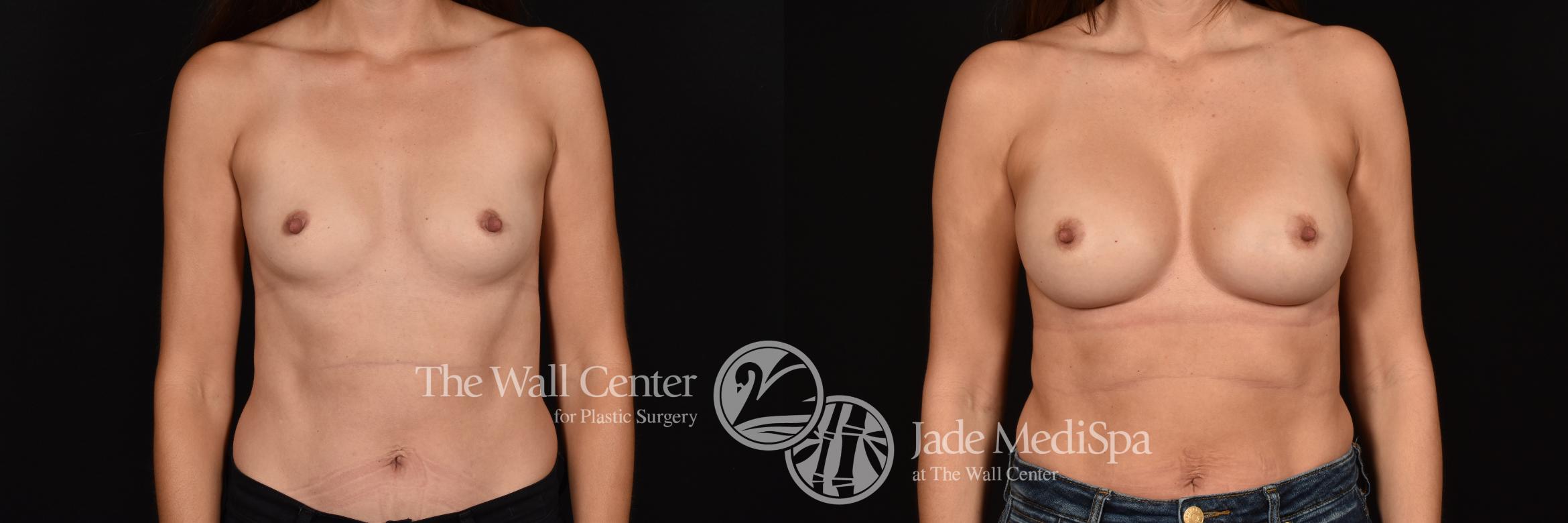 Before & After Breast Augmentation Case 1210 Front View in Shreveport, LA