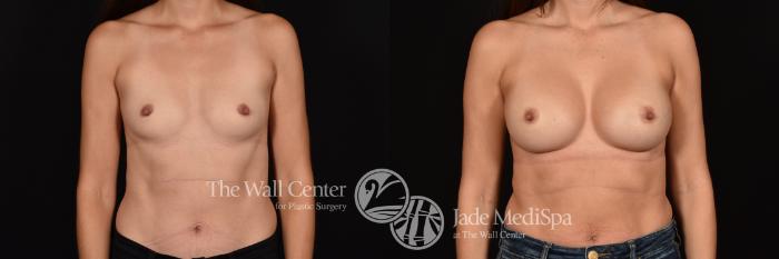 Before & After Breast Augmentation Case 1210 Front View in Shreveport, LA