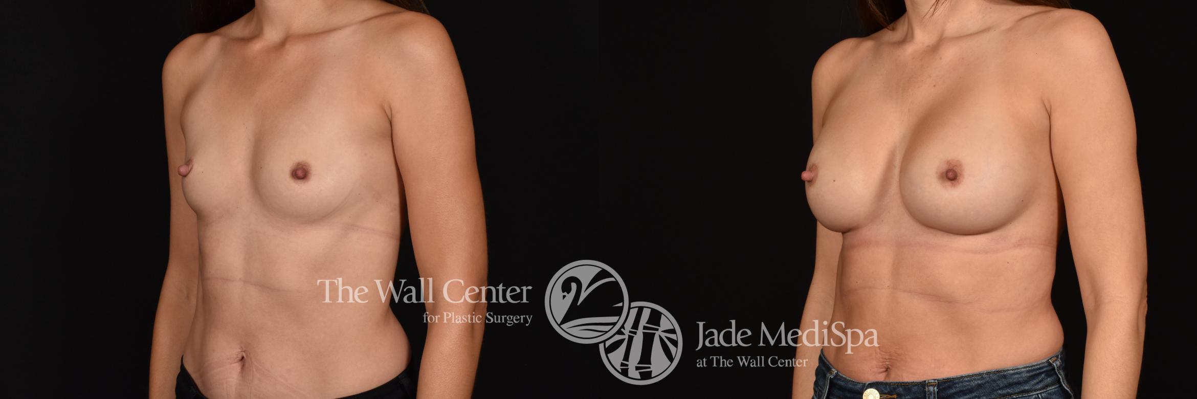 Before & After Breast Augmentation Case 1210 Left Oblique View in Shreveport, LA