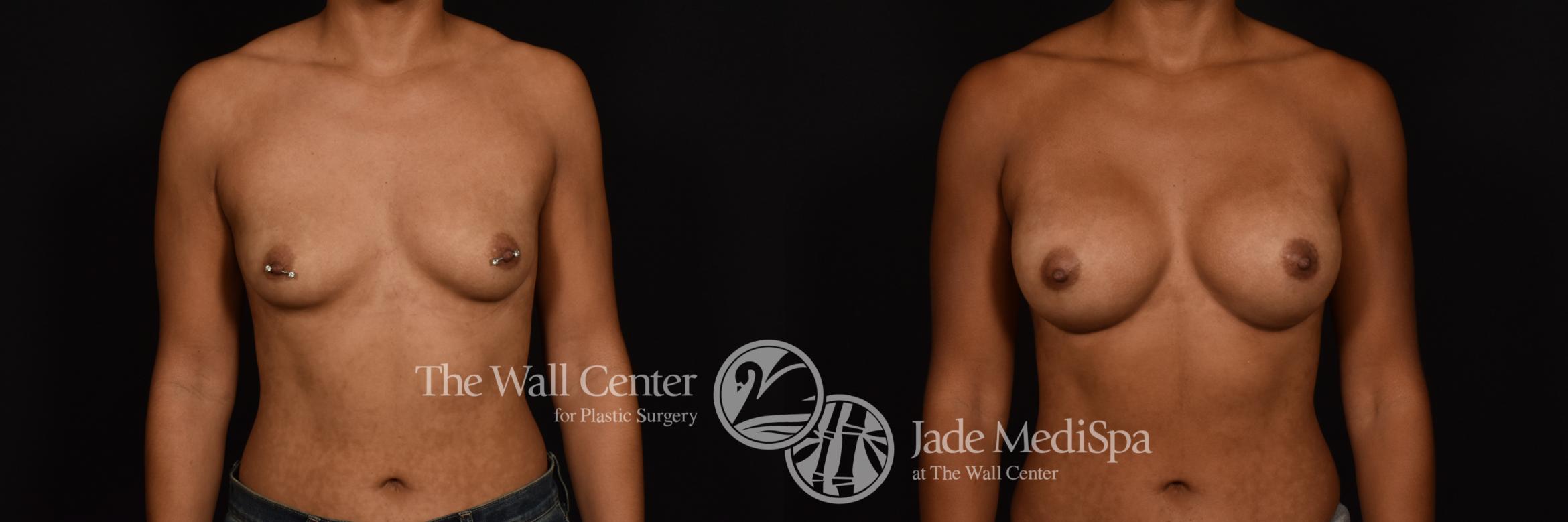 Before & After Breast Augmentation Case 1213 Front View in Shreveport, LA