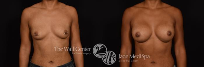 Before & After Breast Augmentation Case 1213 Front View in Shreveport, LA