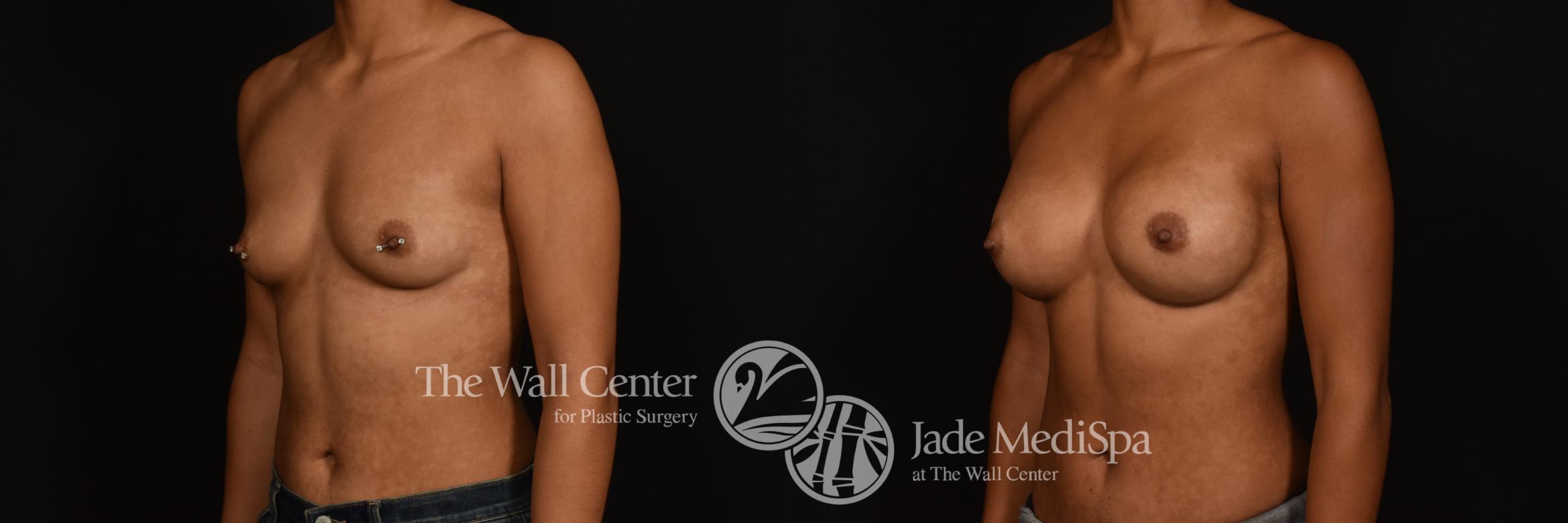 Before & After Breast Augmentation Case 1213 Left Oblique View in Shreveport, LA