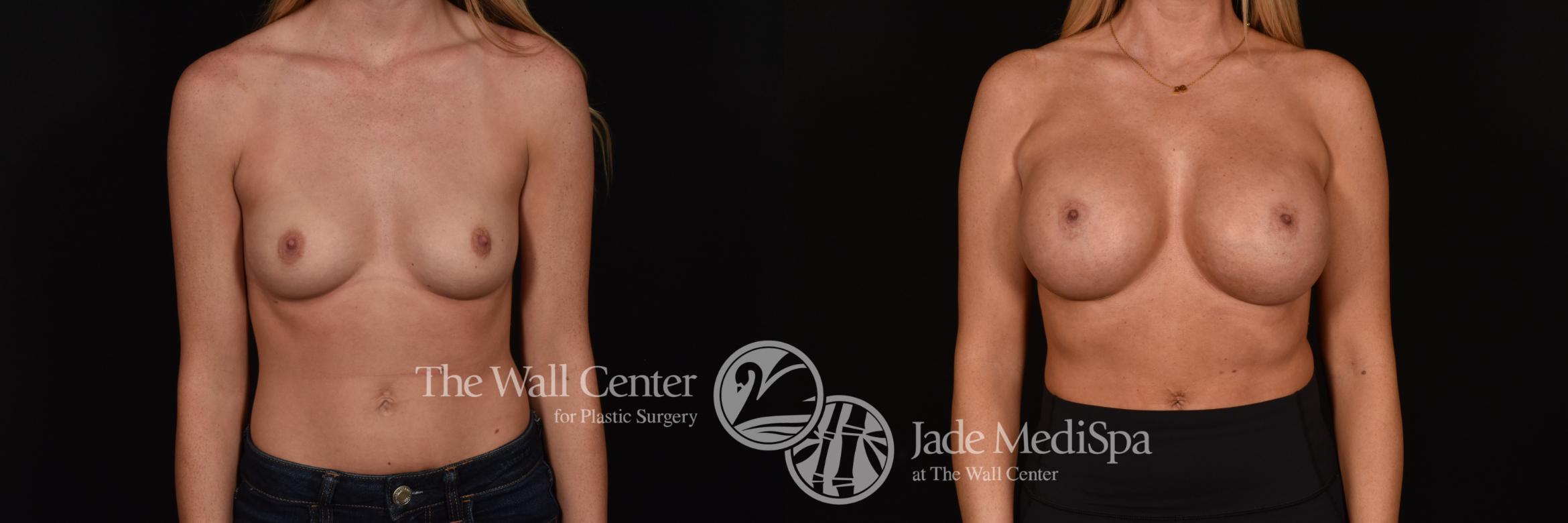Before & After Breast Augmentation Case 1217 Front View in Shreveport, LA