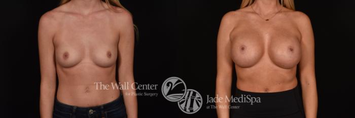Before & After Breast Augmentation Case 1217 Front View in Shreveport, LA