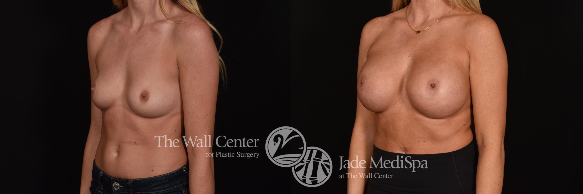 Before & After Breast Augmentation Case 1217 Left Oblique View in Shreveport, LA