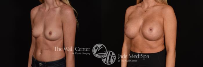 Before & After Breast Augmentation Case 1217 Left Oblique View in Shreveport, LA