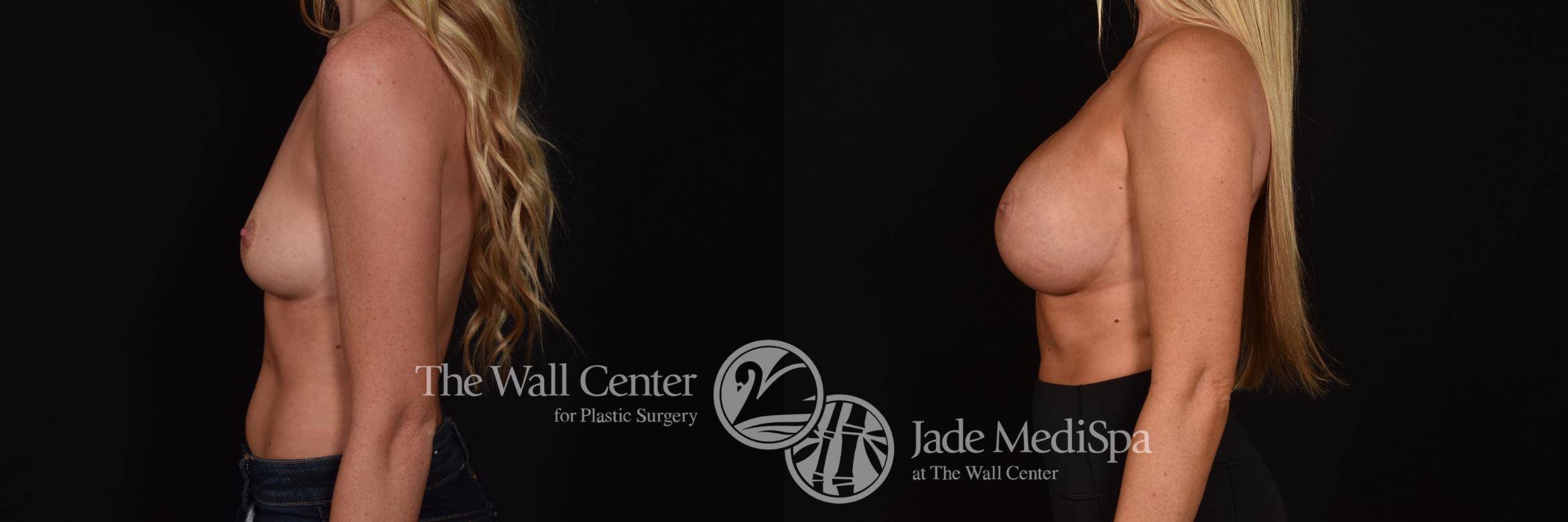 Before & After Breast Augmentation Case 1217 Left Side View in Shreveport, LA