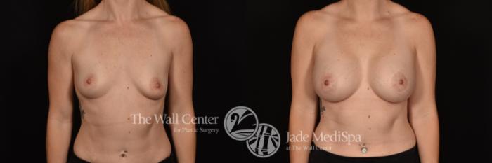 Before & After Breast Augmentation Case 1218 Front View in Shreveport, LA
