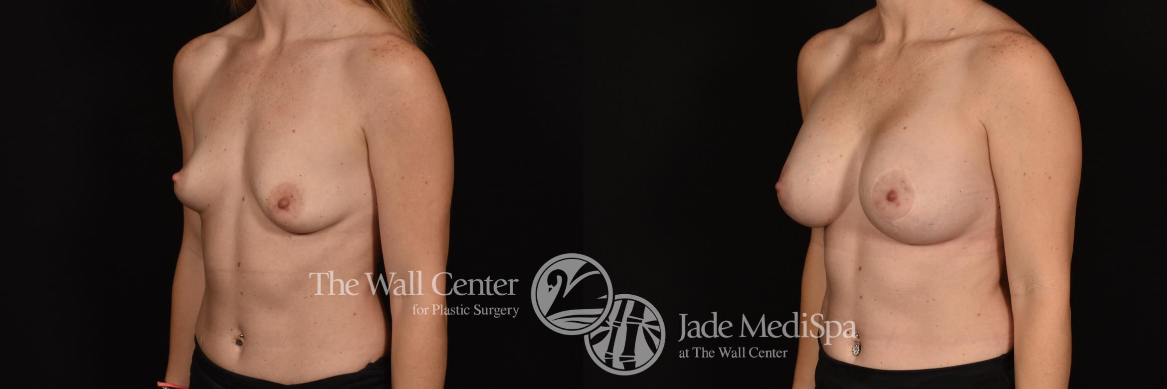 Before & After Breast Augmentation Case 1218 Left Oblique View in Shreveport, LA
