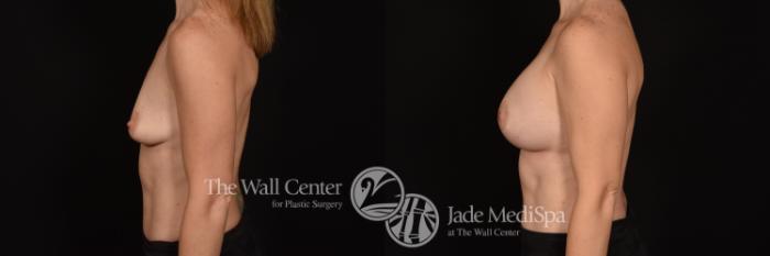 Before & After Breast Augmentation Case 1218 Left Side View in Shreveport, LA