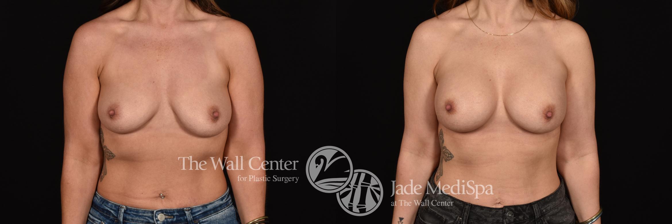 Before & After Breast Augmentation Case 1219 Front View in Shreveport, LA