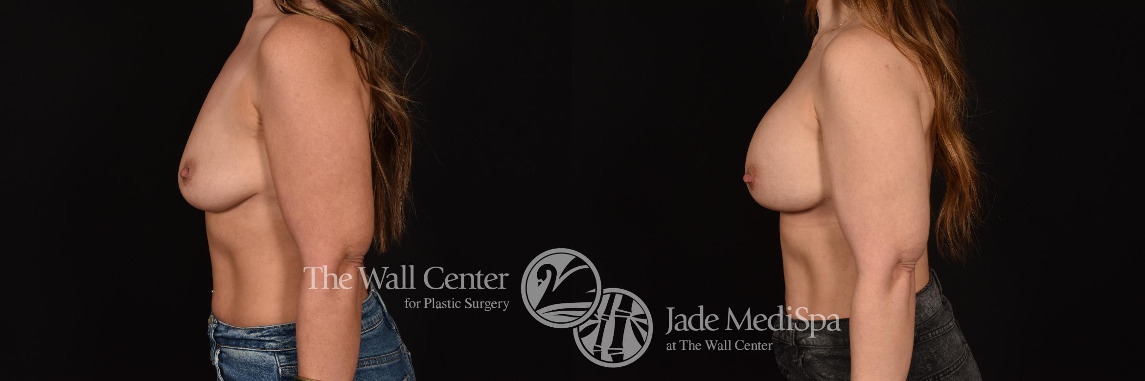 Before & After Breast Augmentation Case 1219 Left Side View in Shreveport, LA