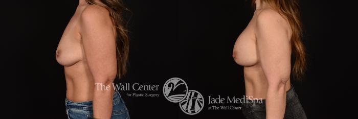 Before & After Breast Augmentation Case 1219 Left Side View in Shreveport, LA