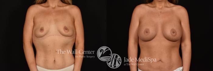 Before & After Breast Augmentation Case 1224 Front View in Shreveport, LA