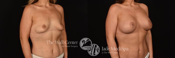 Before & After Breast Augmentation Case 1224 Right Oblique View in Shreveport, LA