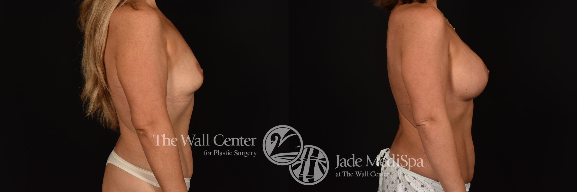 Before & After Breast Augmentation Case 1224 Right Side View in Shreveport, LA