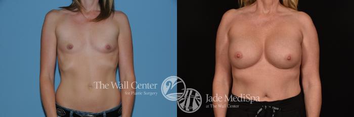 Before & After Breast Augmentation Case 1226 Front View in Shreveport, LA