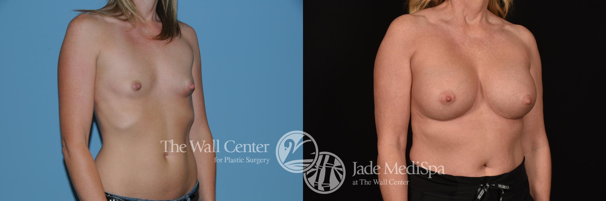 Before & After Breast Augmentation Case 1226 Right Oblique View in Shreveport, LA