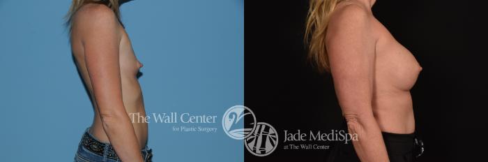 Before & After Breast Augmentation Case 1226 Right Side View in Shreveport, LA