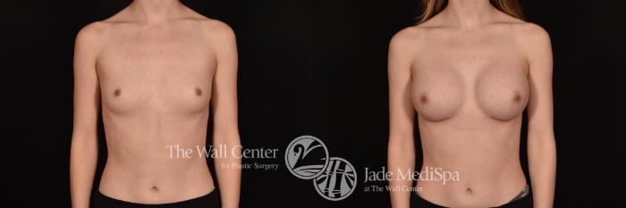Before & After Breast Augmentation Case 1228 Front View in Shreveport, LA