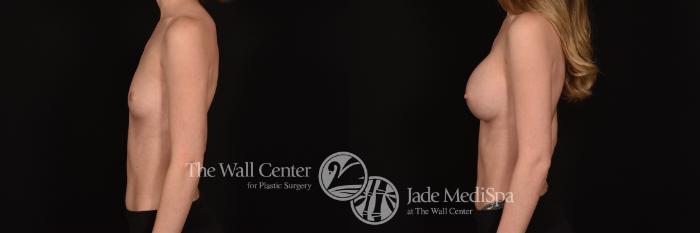 Before & After Breast Augmentation Case 1228 Left Side View in Shreveport, LA