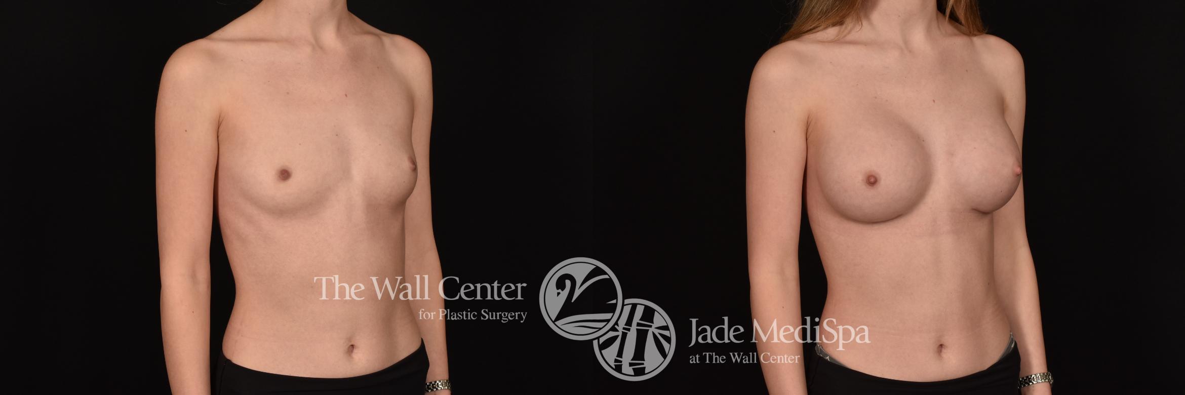 Before & After Breast Augmentation Case 1228 Right Oblique View in Shreveport, LA