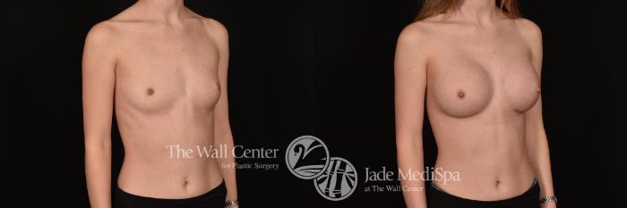 Before & After Breast Augmentation Case 1228 Right Oblique View in Shreveport, LA